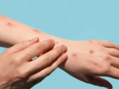 Secretário de Saúde descarta caso de varíola dos macacos em São Luís