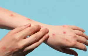 Secretário de Saúde descarta caso de varíola dos macacos em São Luís