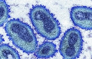 Prefeitura de São Luís informa caso suspeito de Monkeypox