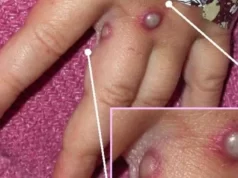 Maranhão registra 2º caso da varíola dos macacos