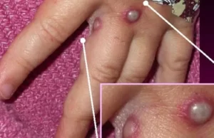 Maranhão registra 2º caso da varíola dos macacos