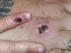 No Maranhão, 1ª morte por varíola dos macacos é registrada em Imperatriz