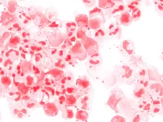 Cinco casos de meningite viral são registrados em São Luís