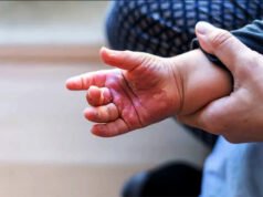 Maranhão registra 126 casos de queimaduras em crianças