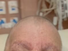 Em tratamento contra câncer, Roseana contrai pneumonia e vai se submeter à cirurgia